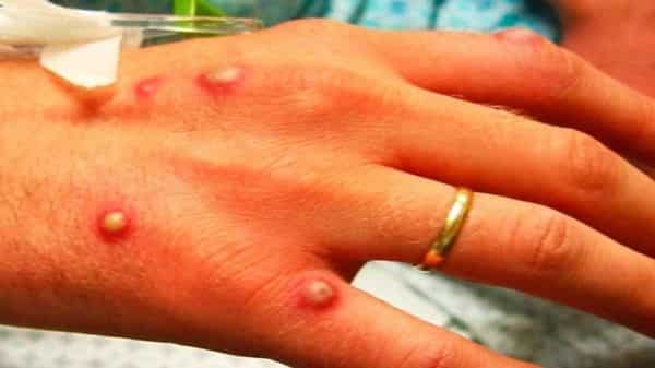 क्यानडामा मङ्कीपक्सका बिरामीको सङ्ख्या हजारभन्दा बढी